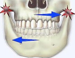 Βρουξισμός δοντιών